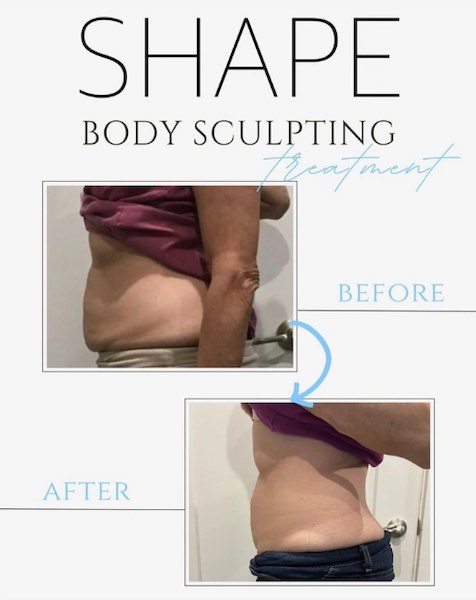 Body Sculpting Before and After