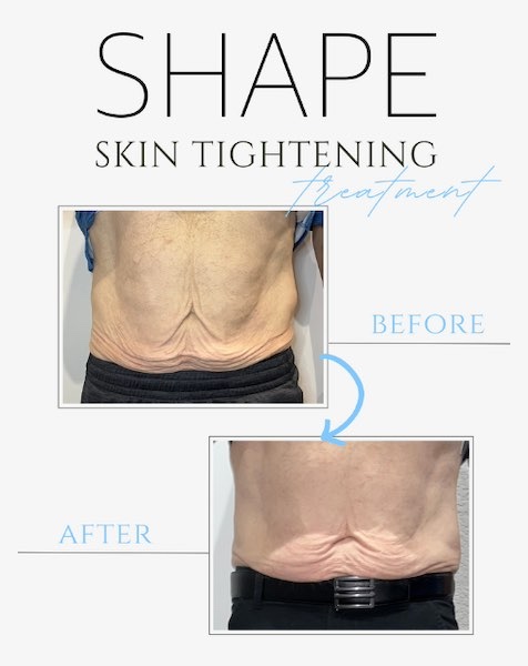 Skin Tightening Prosper Texas