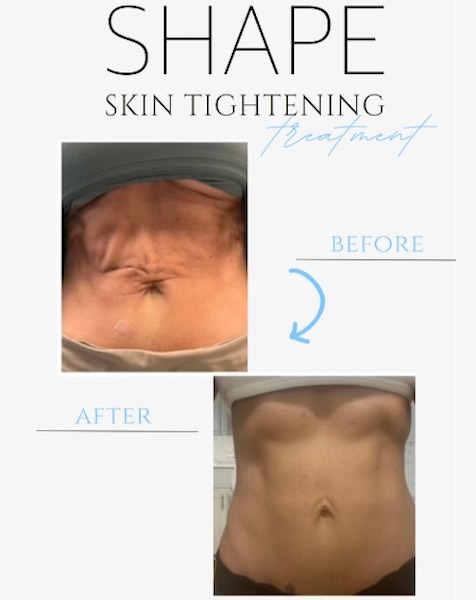 Body Sculpting Shape Frisco
